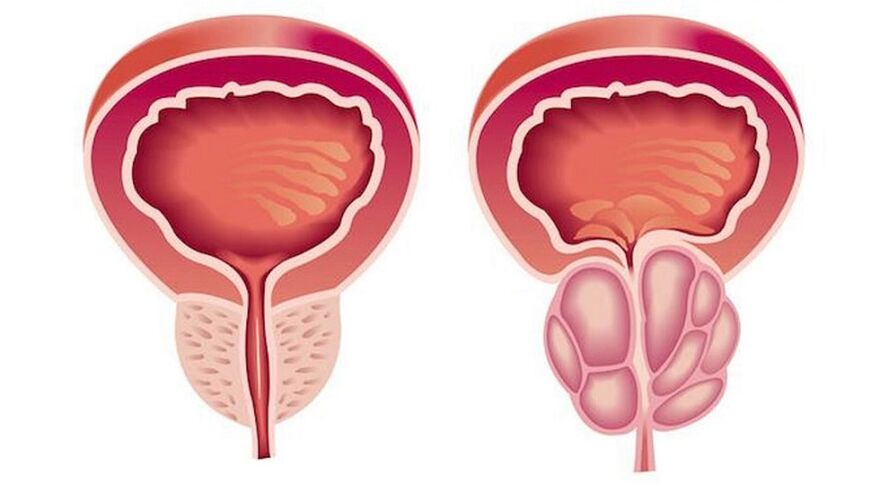 Veselīga un iekaisusi prostatu ar prostatītu