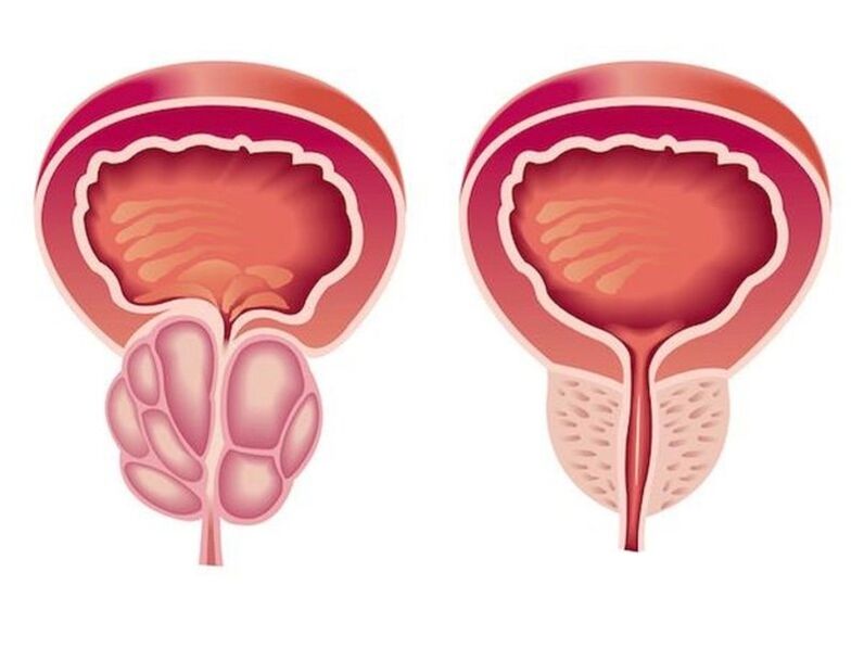 Kā izskatās prostatīts